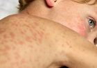 Measles cluster in Maldives climbs to 9 cases