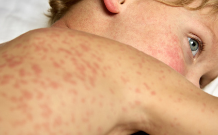 Measles cluster in Maldives climbs to 9 cases