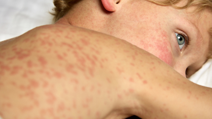 Measles cluster in Maldives climbs to 9 cases